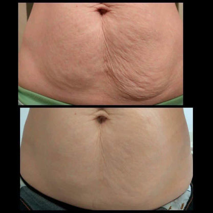 CandelBurn – Crema Reductora Quema-Grasa + Guia de masajes linfaticos 🔥