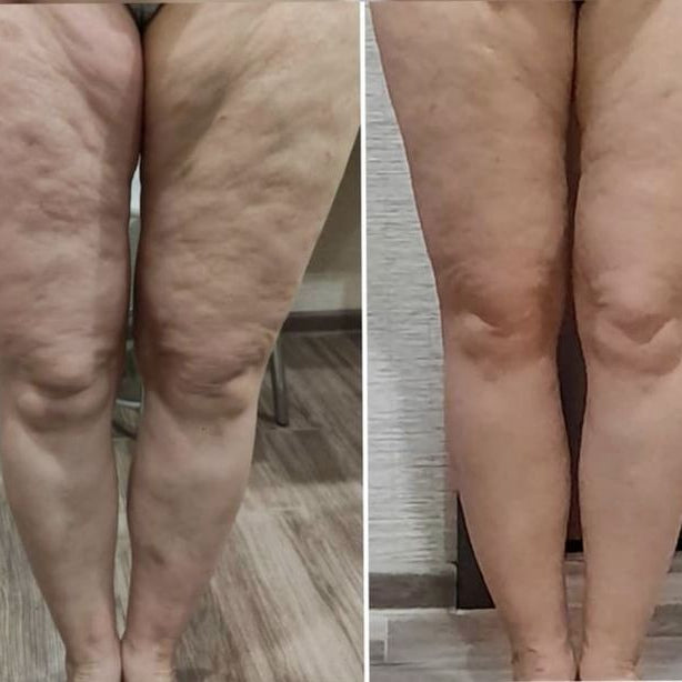 CandelBurn – Crema Reductora Quema-Grasa + Guia de masajes linfaticos 🔥