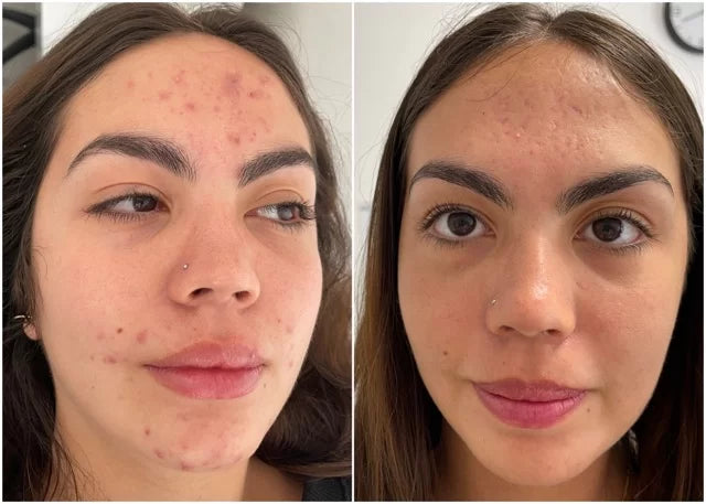 RELIEF 345 SKIN BARRIER Calma ardor, brotes y piel irritada desde la primera aplicación