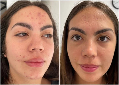 RELIEF 345 SKIN BARRIER Calma ardor, brotes y piel irritada desde la primera aplicación