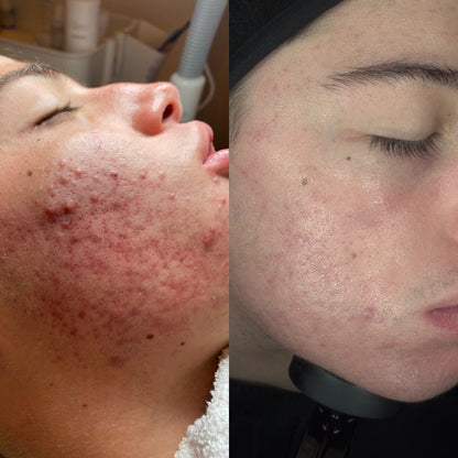 RELIEF 345 SKIN BARRIER Calma ardor, brotes y piel irritada desde la primera aplicación