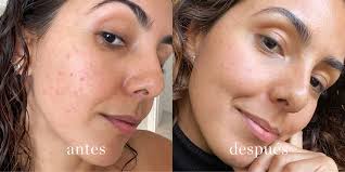 RELIEF 345 SKIN BARRIER Calma ardor, brotes y piel irritada desde la primera aplicación